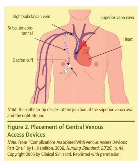 Pdf Restoring Patency To Central Venous Access Devices