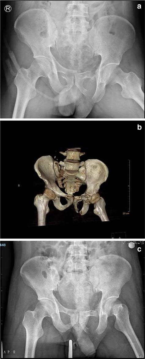 Example Images From The Cases Of Unstable Pelvic Fractures A Xray