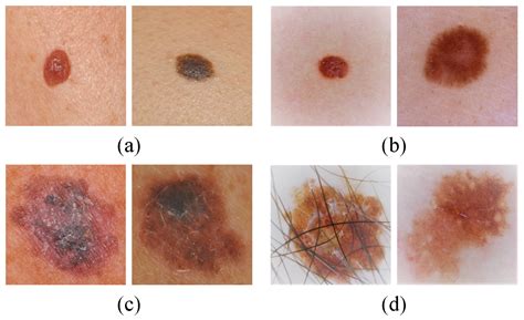 What Does The Early Stage Of Melanoma Look Like Skin Cancer Photos My