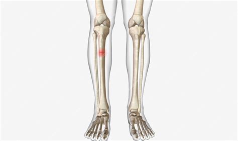 Premium Photo A Fracture Is An Acute Injury That Causes A Partial Or