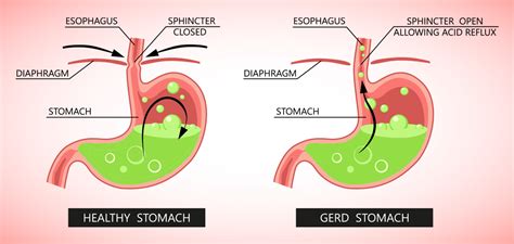 Gastro Esophageal Reflux Treatment Causes Diagnosis Treatment Happiest Health