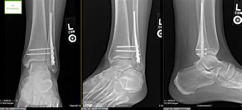 Ankle Fracture Fixated Advanced Foot And Ankle Center Of San Diego