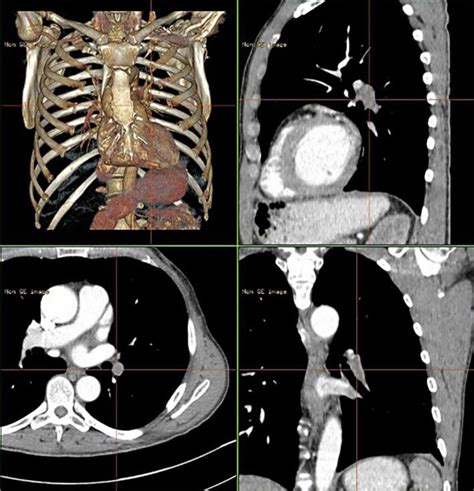 Thoracic Ct Scan Anatomy Ct Scan Machine Images