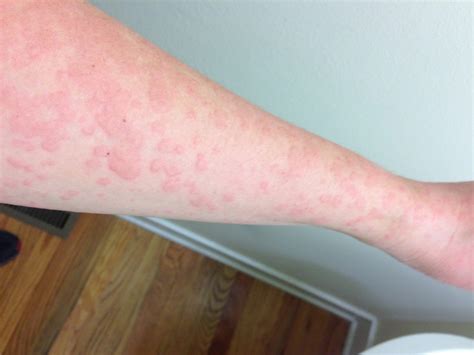 Urticaria Red And Pink Spots On The Skin What To Do Health Care