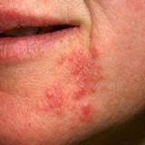 Pictures of Best Makeup For Perioral Dermatitis