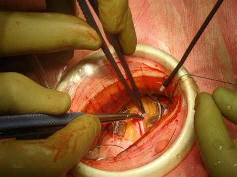 The Evolution Of Coronary Artery Bypass Grafting Coronary Surgery