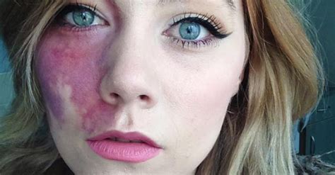 woman with birthmark told she is undateable popsugar beauty