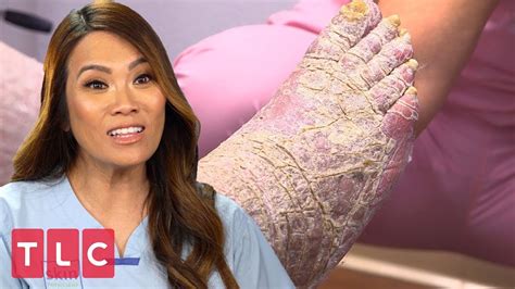 Dr Lee Meets A Man Covered In Dry Scaly Skin Dr Pimple Popper Youtube