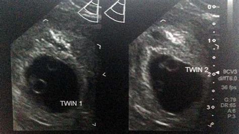 6 Weeks Pregnant With Twins Belly Pictures Symptoms And Ultrasound