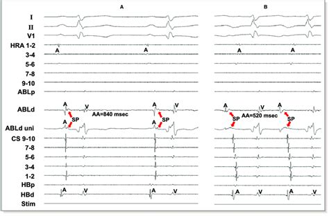 Tracing During Sinus Rhythm A And During Atrial Tachycardia B At