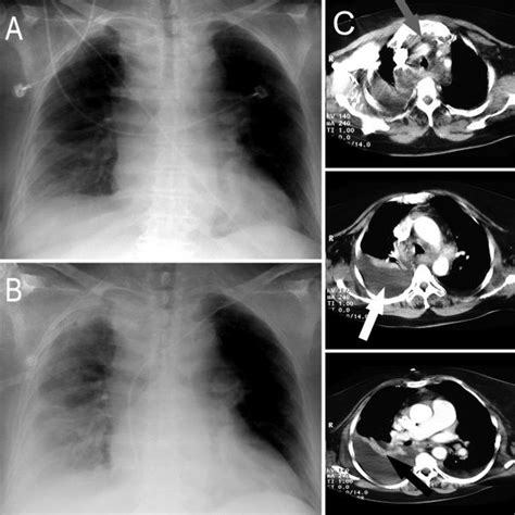 Anteroposterior Chest Radiographs From The Third Postoperative Day A