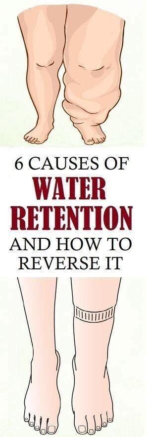 6 Causes Of Water Retention And How To Reverse It Water Retention