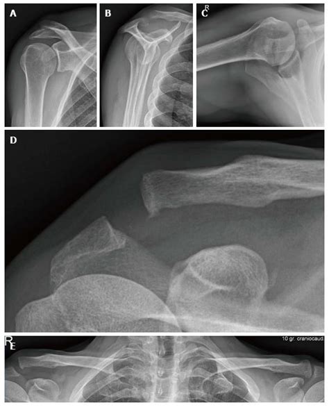 New Insights In The Treatment Of Acromioclavicular Separation