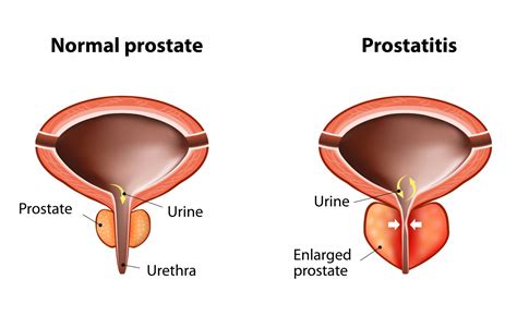 Prostatitis What You Need To Know