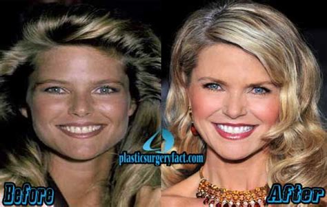 Christie Brinkley Plastic Surgery Before And After Photos Christie