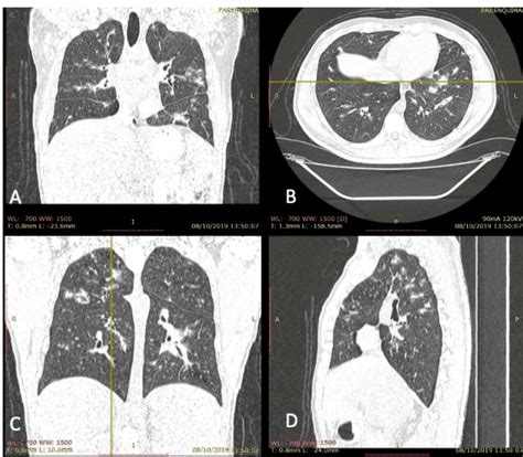 Extensive Pulmonary Involvement In Kaposi Sarcoma In A Patient With