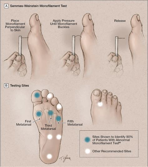 Preventing Foot Ulcers In Patients With Diabetes Neurology Jama