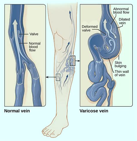 Varicose Veins Linked To Increased Risk Of Deep Venous Thrombosis Scinews