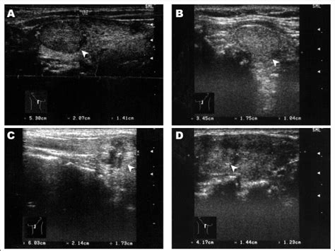 Thyroid Nodule Location On Ultrasonography As A Predictor Of Malignancy