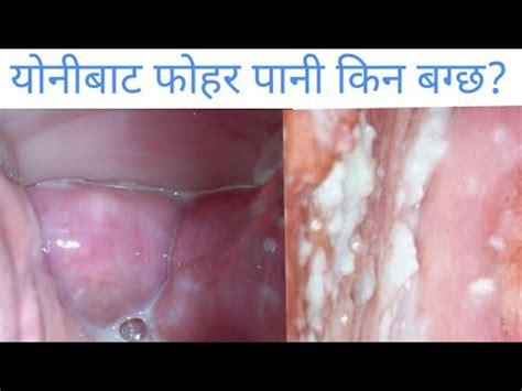 White Discharge In Women In Nepali Dr Ramesh Shrestha Doctor Sathi