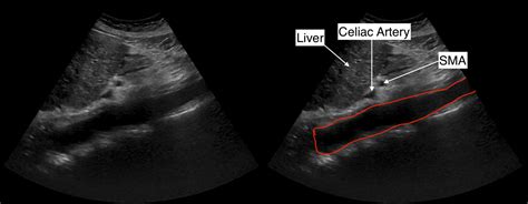 Protocoling Imaging Studies Complete Abdominal Ultrasound Ultrasound