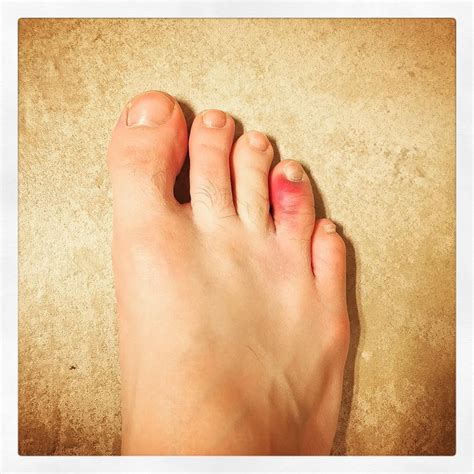 Stubbed A Toe Pretty Hard Yesterday Yesterday Chris Toes Instagram