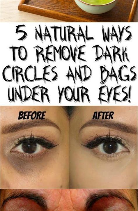 5 Natural Ways To Remove Dark Circles And Bags Under Your Eyes