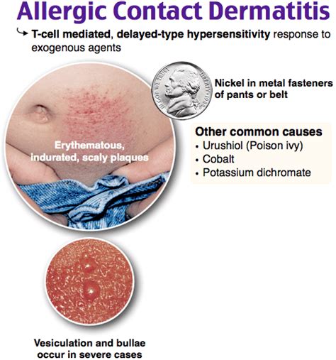 Allergic Contact Dermatitis Erythematous Indurated Grepmed