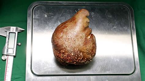 Rimosso il calcolo renale più grande al mondo ha le dimensioni di un pompelmo
