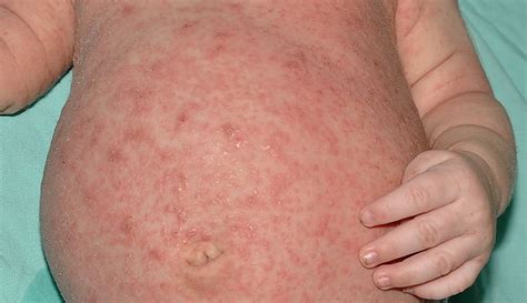 Scabies Causes Symptoms Diagnosis Treatment And Prevention