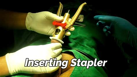 Stapler Circumcision Surgery Procedure Advance Technique Penis Nashik Jabalpur Surat