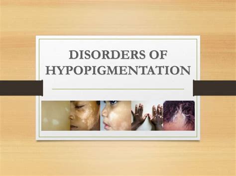 Disorders Of Pigmentation Ppt