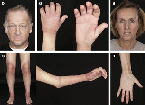 Systemic Sclerosis The Lancet