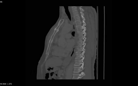 Fractured Sternum Ct Thorax Sagittal Radrounds Radiology Network