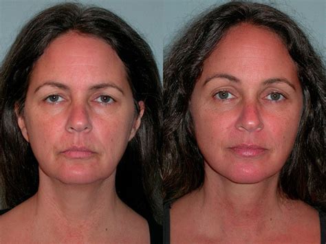 Face And Neck Lift Plastic Surgery In Santa Rosa