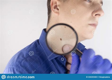 A Man At A Dermatologist Appointment Shows His Birthmarks Moles And