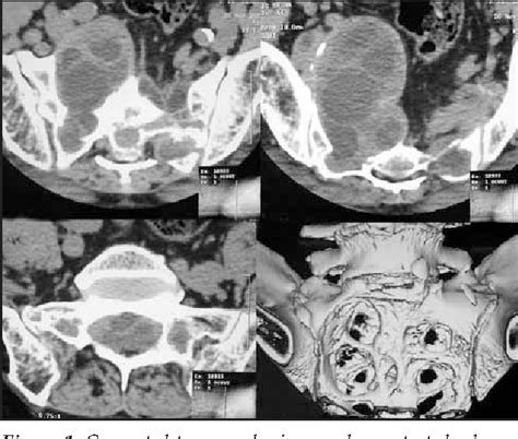 Figure 1 From Combined Anterior And Posterior Approach For Sacral