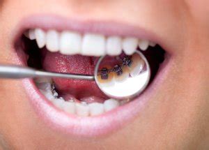Bei ersterer werden die brackets auf der innenseite der zähne befestigt, sodass sie von außen nicht zu sehen sind. Bei der Lingualtechnik wird die Zahnspange innen montiert.