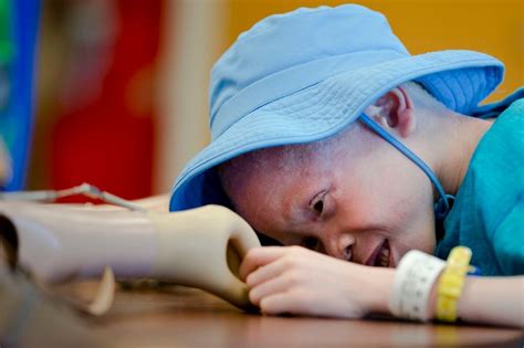 1st Of Tanzanian Albino Kids With Missing Limbs Goes Home The Seattle