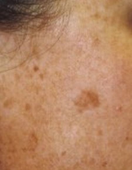 Health Tipssunspots On Skin What Are They And How To