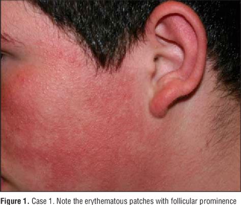 Figure 1 From Keratosis Pilaris Rubra A Common But Underrecognized