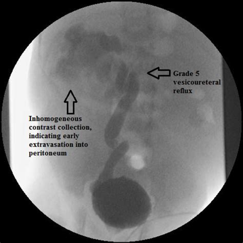 Neonate With Urinary Ascites But No Hydronephrosis Unusual