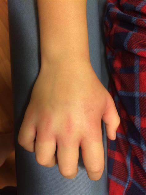 Severe Bee Sting Swelling