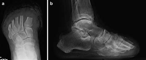 Transmetatarsal And Lisfranc Amputation 2023