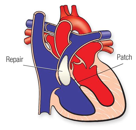 Tetralogy Of Fallot American Heart Association Cpr And First Aid