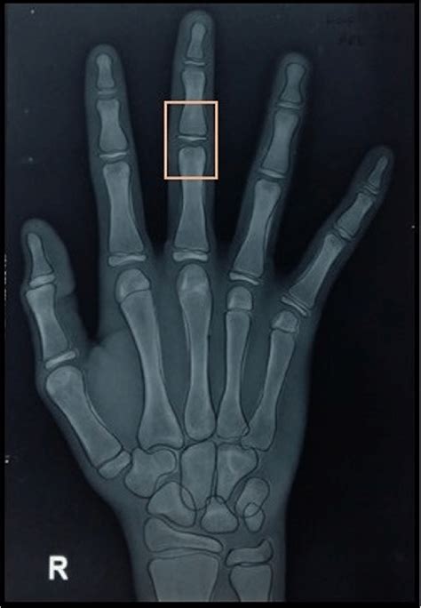 Hand Wrist Radiograph Of A Subject Showing Modified Mp3 Stage Of Right