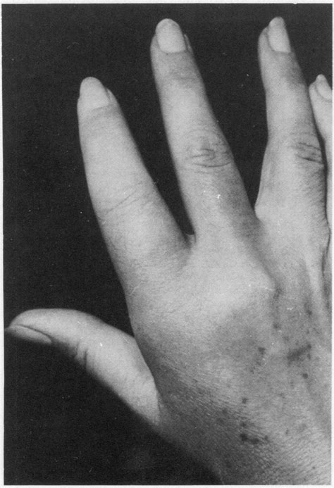 Case 2 Right Hand Showing Diffuse Swelling Ofindex Finger Sausage