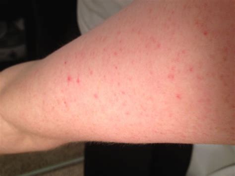 What Does Keratosis Pilaris Look Like Keratosis Pilaris Treatment