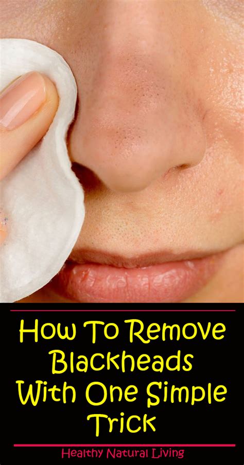 Remove Blackheads With One Simple And Effective Trick Get Rid Of