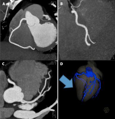 What Is CT Coronary Angiography Prof Sunil Thanvi